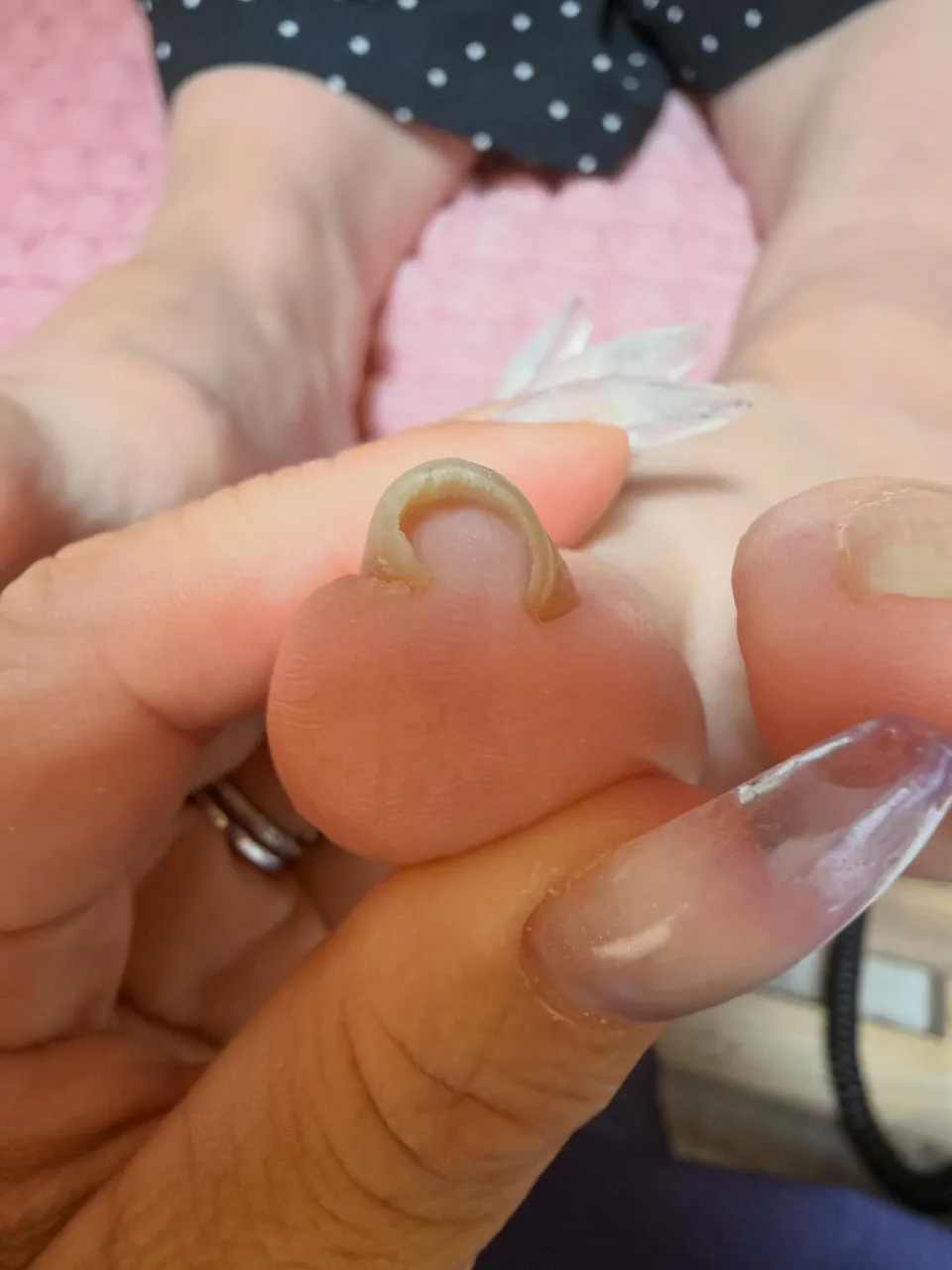 巻き爪でお悩みのお客様