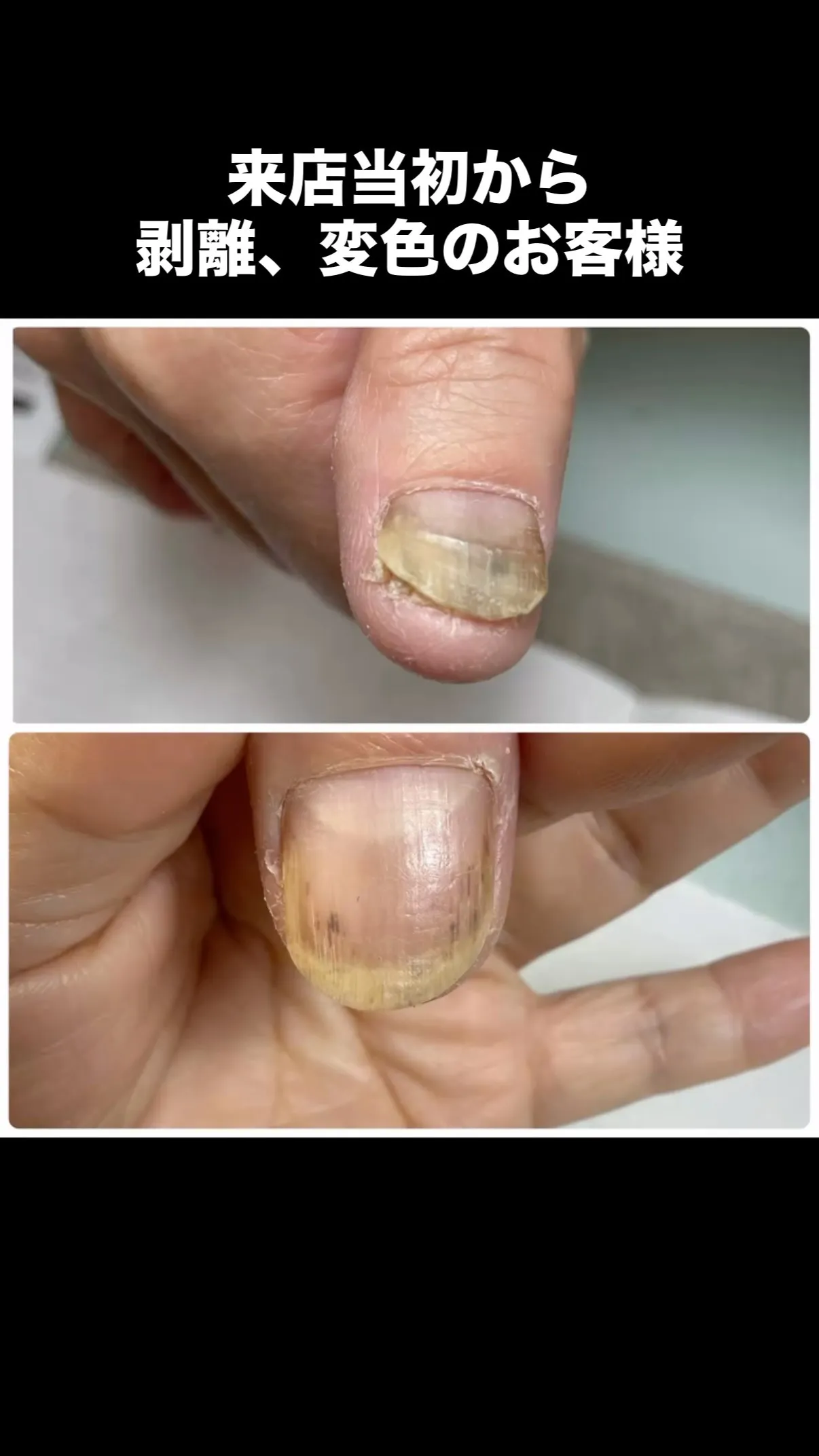 私がトラブル爪にも対応できるようになりたい！！ってきっかけを...